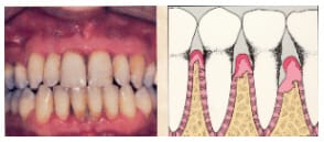early stage of periodontitis